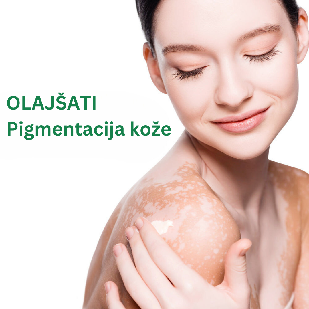 GFOUK™ Pomirjujoča krema TreatVitiligo