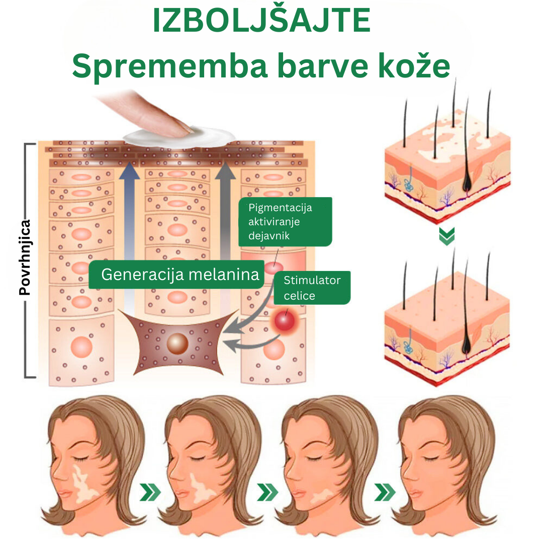 GFOUK™ Pomirjujoča krema TreatVitiligo