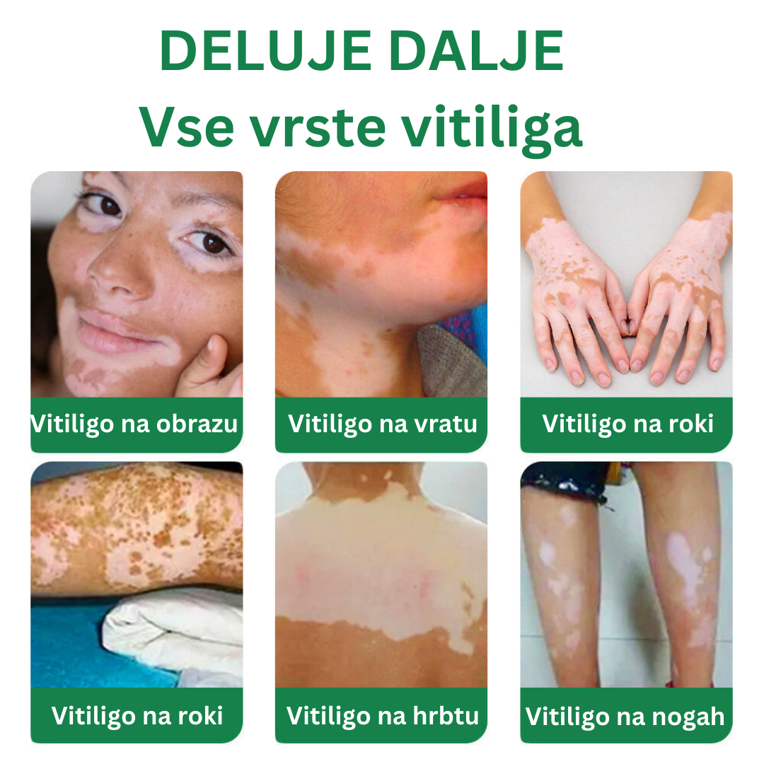 GFOUK™ Pomirjujoča krema TreatVitiligo